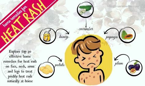 31 Home Remedies For Heat Rash On Face, Neck, Arms And Legs Remedies For Heat Rash, Heat Rash On Face, Heat Rash Remedy, Prickly Heat Rash, Rash Remedies, Rash On Face, Rashes Remedies, Prickly Heat, Healthy Water Drinks