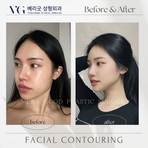 ✨ Achieve Your Dream Look with VG Plastic Surgery! ✨ Korean Surgery, Korean Plastic Surgery, Plastic Surgery, Surgery, Kpop Idol, Dreaming Of You, Photoshop, Beauty