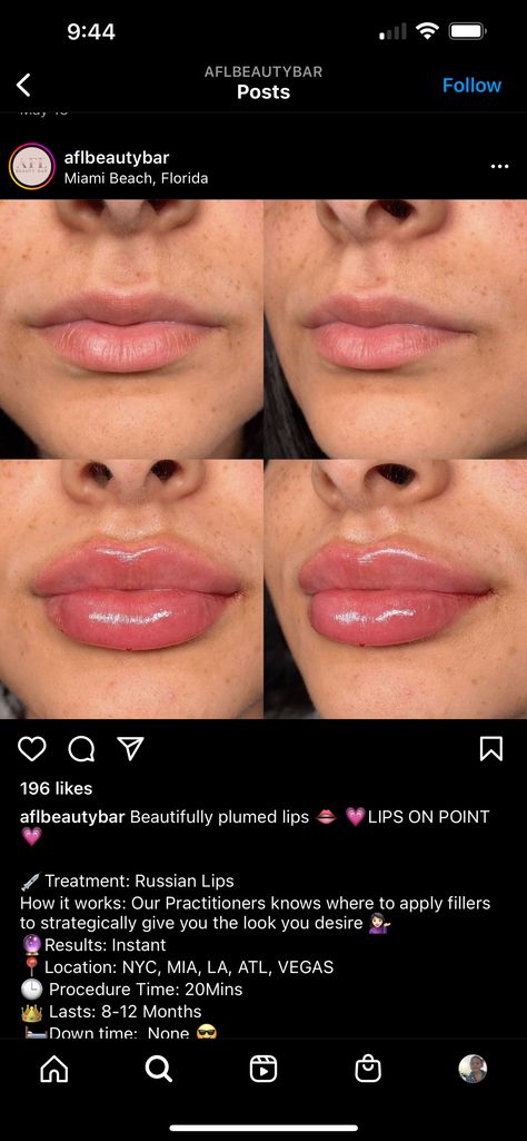 Lip Fillers Juvederm, 1ml Lip Filler, Cupids Bow Lips, Nose Fillers, Natural Pink Lips, Heart Shaped Lips, Lips Inspiration, Botox Lips, Facial Fillers