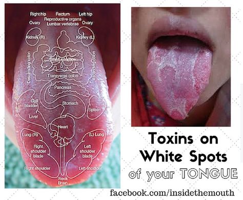 Look for cracks and white spots on your tongue to see where toxins are. #dental #health safariandmd.com Mouth Health, Dental Health, Spot On, Timeline Photos, Health Tips, San Diego, Health, White