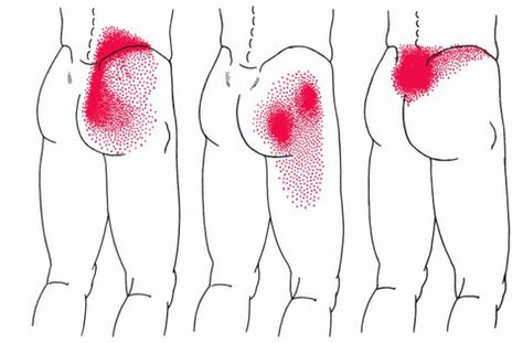 Gluteus Medius Muscle | Anatomy, Function, Pain, & Relief Lower Back Anatomy, Hip Muscles Anatomy, Gluteus Medius Exercises, Exercises For Lower Back Pain, Exercises For Lower Back, Glute Medius, Hip Problems, Sciatica Relief, Gluteus Medius