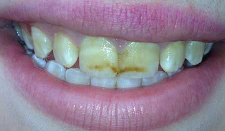 Dental Fluorosis Dental Fluorosis, Beards, Home Remedies, Quick Saves