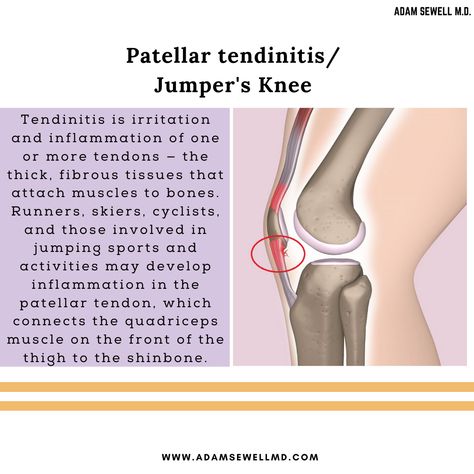 Patellar tendinitis/ Jumper's Knee: Tendinitis is irritation and inflammation of one or more tendons — the thick, fibrous tissues that attach muscles to bones. Our healthcare team works with patients to find both the source of pain, and how to best provide relief. Check our website here - https://www.adamsewellmd.com/typical-home-page . . #Texas #Patellartendinitis #NeuropathyTreatment #pain #Health Patellar Tendon, Jumpers Knee, Knee Problem, Nursing Life, Human Body Anatomy, Body Anatomy, Medical Knowledge, Dance Tips, Nurse Life