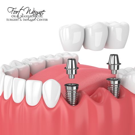 Benefits of Dental Implants: ✅ Regain Your Confidence: Smile with confidence, eat your favorite foods, and laugh without worry. ✅ Lifelong Solution: Dental implants can last a lifetime with proper care. ✅ Preserve Jawbone Health: Prevent bone loss and maintain your facial structure. ✅ Natural Look and Feel: Implants are custom-made to match your existing teeth seamlessly. Dupont☎️ (260) 490-2013 Jefferson☎️ (260) 459-2860 Columbia City☎️ (260) 245-3161 #DrLuga #FortWayne #DentalImplants Clove Dental, Dentistry Design, Dental Animation, Medical Animation, Dental Fillings, Porcelain Veneers, Teeth Implants, Dental Bridge, Dental Art