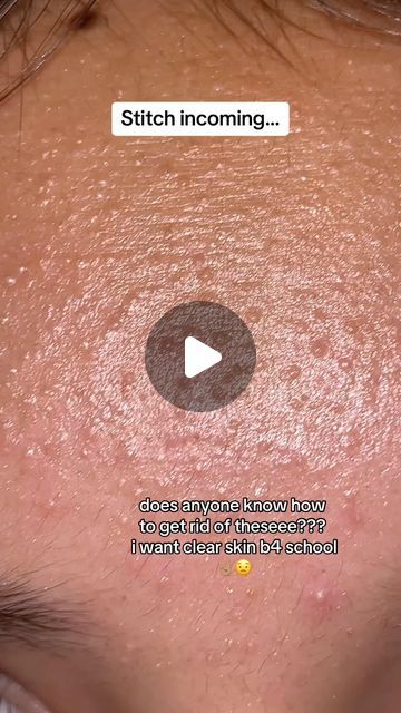 Matt Randon 🧩 on Instagram: "HOW TO GET RID OF BUMPY SKIN!😱 (follow for more!💗)  #skincarecommunity #skincarejunkie #skincareroutines #skincarelover #beautyaddict #beautyobsessed #acnetreatment #acneproblems #acnetips" Skin Care Products For Bumpy Skin, Skin Care Bumpy Skin, Heat Bumps On Face, Skin Care For Bumpy Skin, How To Get Rid Of Bumps On Forehead, How To Get Rid Of Little Bumps On Face, How To Remove Tiny Bumps On Face, How To Get Rid Of Red Spots On Face, Bumpy Face Skin