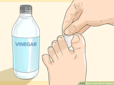 3 Ways to Get Rid of Calluses - wikiHow Callus Remover Diy, Get Rid Of Corns, Feet Care Calluses, Callous Remover, Warts On Hands, Remove Skin Tags Naturally, Skin Moles, Skin Growths, Get Rid Of Warts