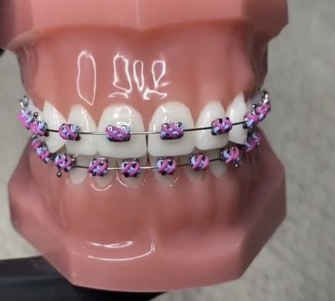 Braces Dark Purple, Purple Braces For Black Women, Violet Braces, Dark Purple Braces, Braces Combos, Lavender Braces, Brace Colors, Purple Braces, Dental Braces Colors