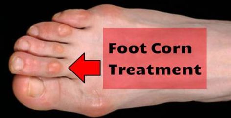 Get Rid Of Corns, Corn Removal, Warts On Face, Warts Remedy, Get Rid Of Warts, Homemade Remedies, Natural Home Remedies, Natural Treatments, Health Remedies