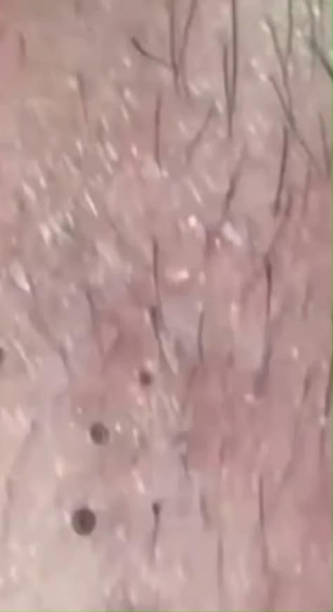 Removing All These Ugly Blackheads Removing Blackheads From Nose Videos, Squeezing Blackheads, Nose Pimples, Visual Asmr, To Remove Pimples, Pimple Removal, How To Remove Blackheads, Remove Pimples, Skin Picking