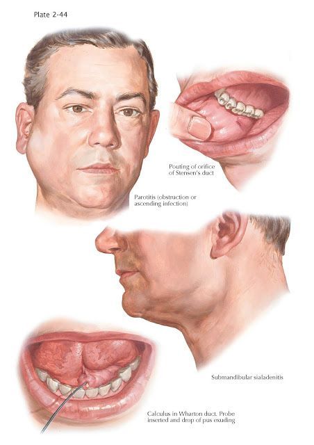 Inflammation of Salivary Glands   The major salivary glands and the accessory mucous glands are subject to … | Salivary gland, Parotid gland, Parotid gland swelling #Parotid_Gland_Swelling #Salivary_Gland_Infection #Salivary_Gland_Stone #Swelling_Remedies Parotid Gland Swelling, Salivary Gland Infection, Salivary Gland Stone, Swelling Remedies, Facial Swelling, Homemade Horseradish, Salivary Glands, Mouth Hygiene, Congratulations Images