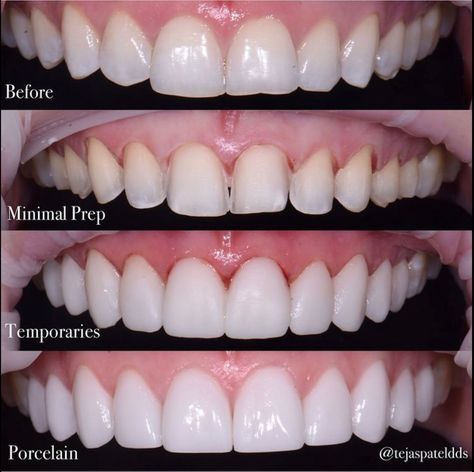 Veneers Best Veneers Teeth, Veneers Black Women, Porcelain Veneers Before And After, Bad Veneers, Veneers Teeth Styles, Veneers Before And After, Celebrities With Veneers, Veneers Aesthetic, Teeth Goals