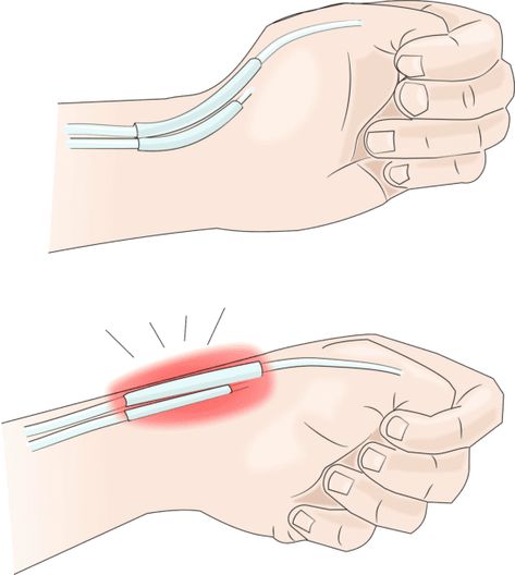 Thumb Pain: What is De Quervain's Tendinosis & How Do You Fix It? – Brookfield Chiropractor Thumb Exercises, Thumb Pain Relief, Trigger Finger Exercises, Broken Thumb, Hand Therapy Exercises, Carpal Tunnel Exercises, Body Pressure Points, Dupuytren's Contracture, Wrist Pain Relief