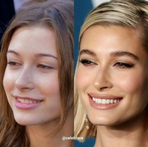 #fashion, #style, #outfitinspiration, #beauty Hailey Bieber Lip Filler, Lip Filler Smile, Hailey Bieber Smile, Hailey Bieber Lips, Kpop Plastic Surgery, Jaw Reduction Surgery, V Line Surgery, Plastic Surgery Fail, Hayley Bieber