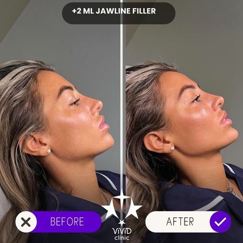 💉✨ Sculpt and define your face with Jawline Filler at Vivid Clinic! Check out this stunning Client Transformation—perfectly contoured, sharper jawline for a more defined and balanced appearance. 💎 ✅ Enhances facial definition ✅ Non-surgical with immediate results ✅ Long-lasting, natural-looking transformation 💬 Want to achieve a similar look? Book your free consultation today and take the first step toward a more sculpted you! 📍Located in Istanbul, Turkey 🌐 vividclinic.net 📞 🇺🇸 +90 545 742... Facial Balancing Filler, Facial Definition, Sharper Jawline, Jawline Filler, Facial Balancing, Skincare On A Budget, Mom Makeover, Body Contouring Surgery, Face Fillers