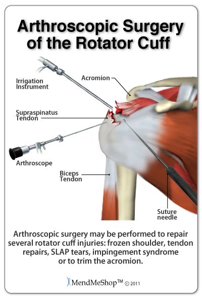 Supraspinatus Tendon Tear, Rotator Cuff Surgery Recovery, Arthroscopic Shoulder Surgery, Shoulder Anatomy, Rotator Cuff Surgery, Rotator Cuff Exercises, Shoulder Pain Exercises, Psoas Release, Shoulder Rehab