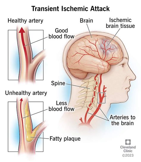 Transient ischemic attack: Don’t ignore the warning Food For Heart, Yoga Information, Physical Inactivity, Carotid Artery, Brain Tissue, Medical Emergency, Cleveland Clinic, Joints Pain Relief, The Warning