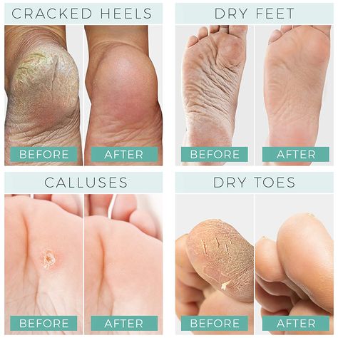 Foot Peel Mask, Dry Heels, Peeling Mask, Rough Heels, Skin Hand, Foot Mask, Foot Soak, Cracked Heels, Ingrown Toe Nail