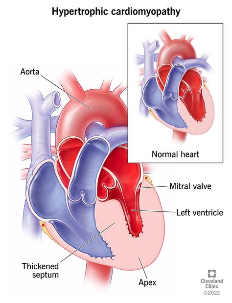 Heart Chambers, Chambers Of The Heart, Heart Structure, Subarachnoid Hemorrhage, Tricuspid Valve, Heart Diagram, Types Of Strokes, Mitral Valve, Blood Pressure Control