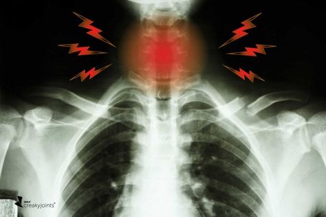 Scleroderma Symptoms, Scleroderma Awareness, Smooth Muscle Tissue, Eddie Kaspbrak, Reflux Disease, Stomach Acid, Scar Tissue, Muscle Tissue, Red Flags