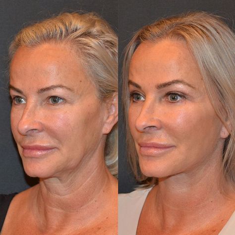 Dr. Ambe || NB Plastic Surgery on Instagram: “Here it is, the full face before and after showing not just her eyes like we did most recently but her full #facelift and #necklift before…” Face Lifting, Lift Face With Makeup, Before And After Face Lift, Thread Face Lift Before And After, Lower Face And Neck Lift, Mid Face Lift, Lower Face Lift Before And After, Neck Lift Surgery, Face Plastic Surgery