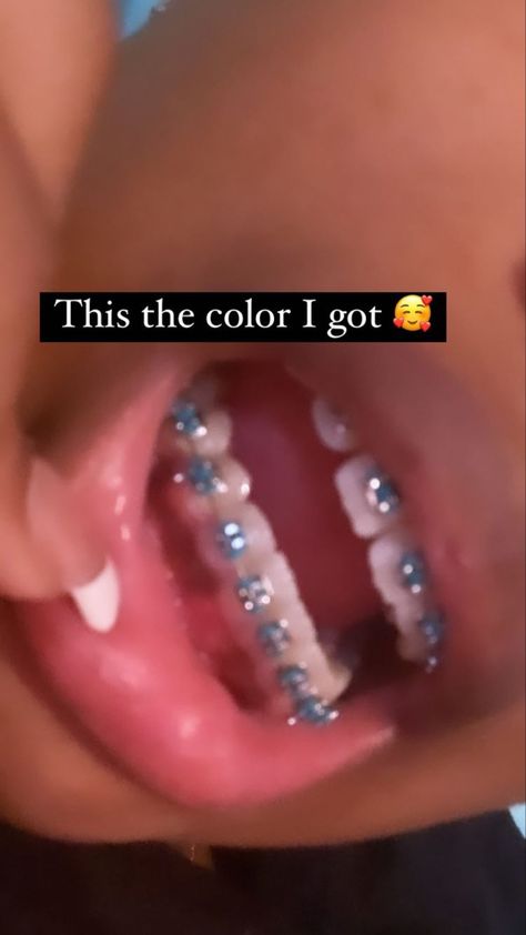 Braces Colors Two Colors, Tightening Braces, Straight Teeth With Braces, Braces Y2k, Braces Colors Ideas Dark Skin Women, Light Green Braces, Royal Blue Braces Teeth, Light Pink Braces Aesthetic, Braces Inspo Colors