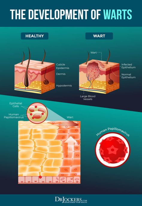 Skin Warts: Major Causes and Natural Support Strategies - How To Treat Warts, Filiform Wart, Flat Warts, Facial Warts, Skin Wars, Warts Remedy, Wart Remover, Get Rid Of Warts, Hair Removal Cream