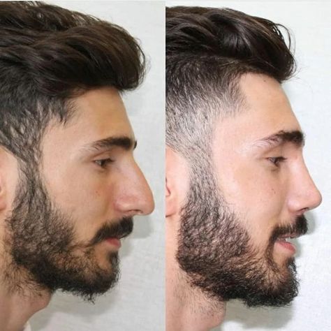 Mens Nose Job, Male Nose Job Before And After, Male Plastic Surgery Before After, Men Nose Job, Men Rhinoplasty, Male Nose Job, Male Rhinoplasty, Liquid Rhinoplasty, Male Nose