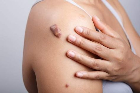 Keloid result from skin’s overreaction to injuries. Here is how to flatten keloid scars naturally, without requiring extreme treatments. Get Rid Of Keloids, Scar Remedies, Hypertrophic Scars, Making Essential Oils, Natural Healing Remedies, Scar Removal, Laser Therapy, Skin Disorders, Scar Tissue