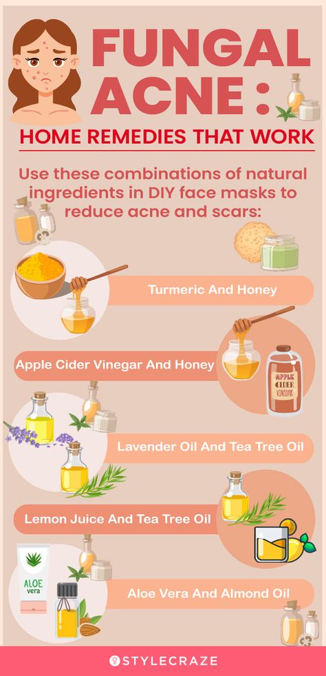 Back Acne Remedies, Cystic Acne Remedies, Blind Pimple, Fungal Acne, Acne Overnight, Acne Vulgaris, Diy Acne, Natural Acne Remedies, Natural Acne