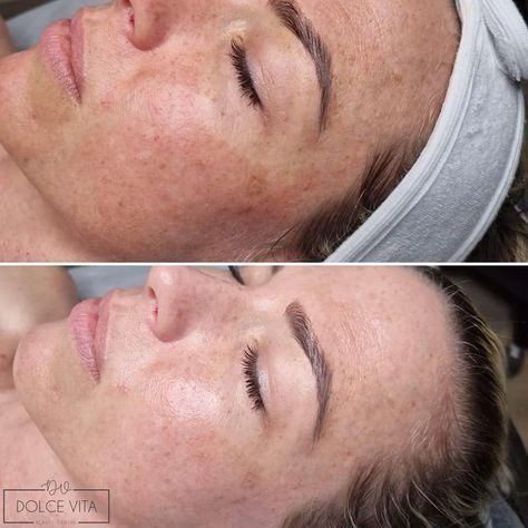 Everything You Need to Know About Azelaic Acid Peel Best Chemical Peel, Chemical Peel At Home, Post Inflammatory Hyperpigmentation, Acid Peel, Azelaic Acid, Chemical Peel, Gentle Exfoliator, Skin Care Treatments, Even Skin Tone