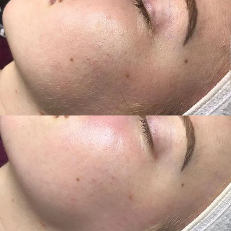 Oilplaning: What Are the Pros of Dermaplaning With Oil? Before And After Dermaplaning, Dermaplaning Before And After, Dermaplaning Benefits, Dermaplaning Facial, Facial Images, Vellus Hair, Deep Exfoliation, Skincare Quotes, Cystic Acne