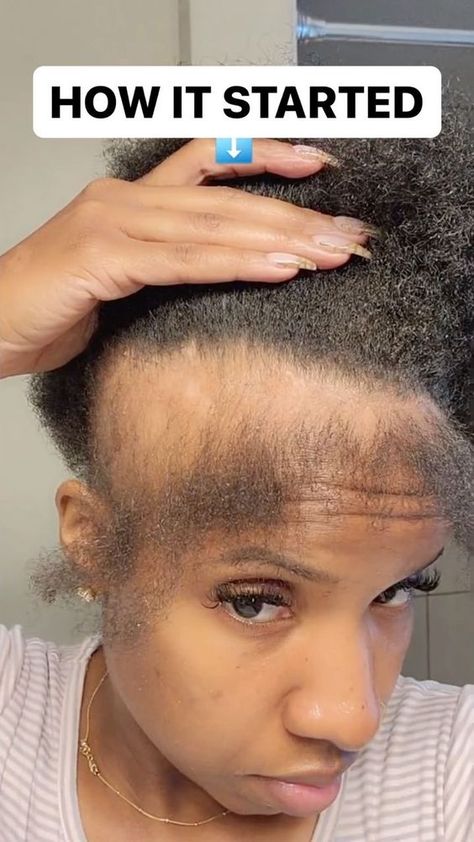 Natural Black Hairstyles Short, Traction Alopecia Hairstyles, Braids For Alopecia For Black Women, Alopecia Braid Styles, Hairstyles For Alopecia, Alopecia Hairstyles Black Women, Short Braids For Black Women, Short African Hairstyles, Black Hair Quick Weave