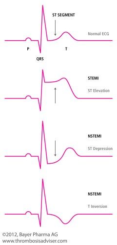 Stemi Stemi Ekg, Paramedic School, Nursing Information, Nursing School Essential, Nursing School Motivation, Nurse Study Notes, Nursing Mnemonics, Nursing Student Tips, Cardiac Nursing