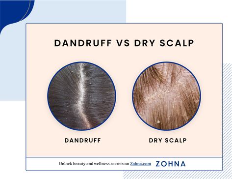 Dandruff vs Dry Scalp Guide: Differences, Causes & Solutions Dry Scalp Vs Dandruff, What Causes Dandruff, Scalp Spa, Dandruff Causes, Dandruff Solutions, Home Remedies For Dandruff, Short Hair Inspiration, Dandruff Remedy, Oily Scalp