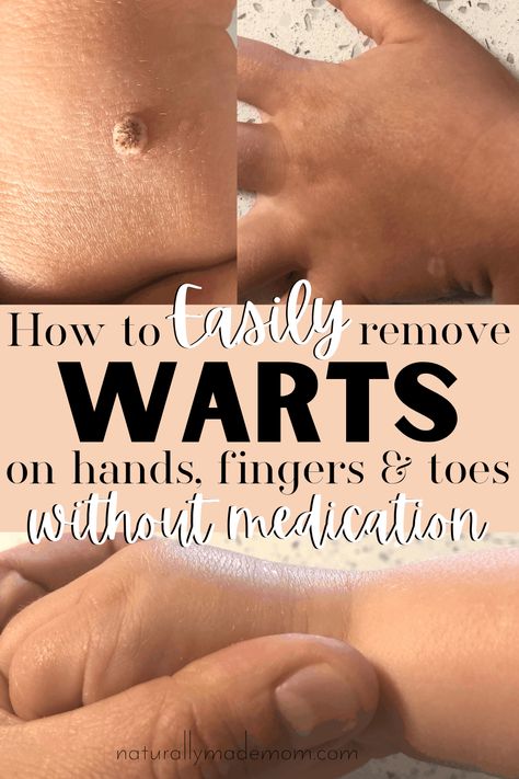 Wart On Finger, Warts On Hands, Home Remedies For Warts, Remove Skin Tags Naturally, Warts Remedy, Wart Remover, Get Rid Of Warts, Home Remedy For Cough, Skin Natural Remedies