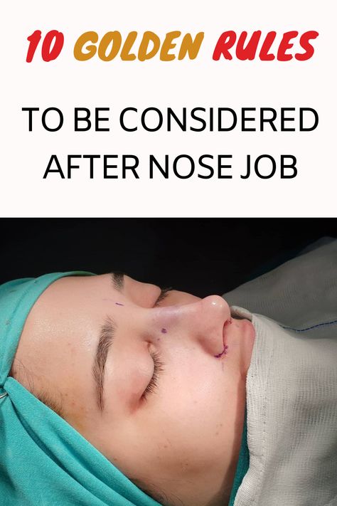 Rhinoplasty (nose job) provides a beautiful nose that is compatible with the face and aesthetically pleasing. In rhinoplasty, it is very important for the patient to fully trust her doctor and decide together on the procedure to be performed. In rhinoplasty, the basic principle is to obtain the desired shape by preserving the basic functions of the nose. If the patient needs it, many other procedures can be performed during rhinoplasty surgery. Rhinoplasty Swelling Progression, Rhinoplasty Recovery Tips, Nose Inspiration Rhinoplasty, Broken Nose Surgery, Bulbous Nose Rhinoplasty Before After, Rhinoplasty Recovery Timeline, Nose Job Recovery, Swelling Remedies, Rhinoplasty Recovery