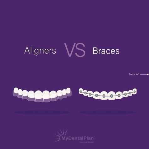 Deciding between braces and aligners can be confusing. According to a survey conducted by American Dental Association in 2015, It’s reported that 25% of people avoid smiling due to the condition of their mouth and teeth. 

An invisible teeth aligner or a metal brace may help you achieve a smile you're proud of if you're experiencing embarrassment due to crooked or misaligned teeth. However, you must weigh the pros and cons before choosing between aligners and braces. 



#MyDentalPlan Aligners For Teeth, Dental Marketing Social Media, Teeth Aligners, Dental Wall Art, Dental Branding, Types Of Braces, Dental Advertising, Misaligned Teeth, Teeth Alignment