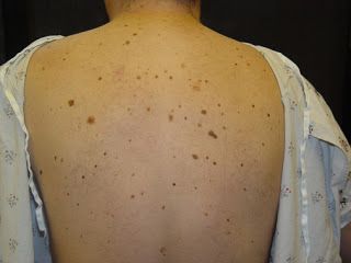 Study Medical Photos: A Young Male Presents With Multiple Moles On His B... Mole Meaning, Facial Mole, Moles On Face, Dark Mole, Benefits Of Baking Soda, Facial Warts, Red Moles, Remove Skin Tags Naturally, Remove Skin Tags