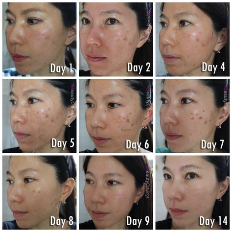 Vi Peel, Derma Rolling, Facial Scars, Acid Peel, Behind Closed Doors, Self Concept, Peeling Skin, Chemical Peel, Closed Doors