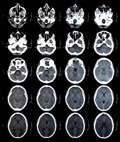 Ct Scan Brain, Diagnostic Radiography, Scanning Stand, Computed Tomography, Samurai Mask, Brain Scan, Ct Scan, Andrew Martin, Ayat Alkitab