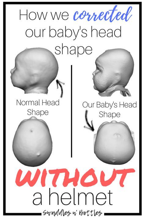 How we corrected our baby's flat head without a baby helmet. It was suggested that our daughter be put in a Doc Band at 4.5 months of age. We did a variation of alternative exercises and increased tummy time activities which drastically helped change the shape of her head to the point where the Doctor advised us a helmet was no longer necessary! Baby Head Shape, Flat Head Baby, 5 Month Old Baby, 4 Month Old Baby, Baby Helmet, Tummy Time Activities, Baby Advice, Baby Supplies, Newborn Care