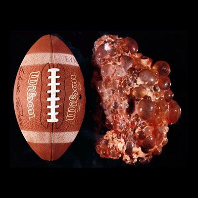 PKD kidney next to a football Polycystic Kidneys, Kidney Donor, Genetic Diseases, Organ Donation, Genetic Disorders, Medical Anatomy, Kidney Health, A Football, Genetic