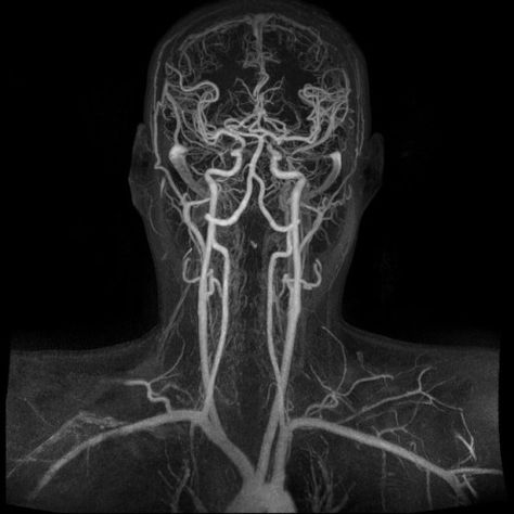 A portrait in blood vessels.Magnetic resonance angiography (MRA) is a specialised medical imaging technique used to visualise blood vessels. Here, tangled white tubes represent the major blood vessels of the head, neck and upper thorax. Looking at the uppermost portion of the image, one can see the silhouette of the brain whilst the aortic arch takes the center bottom. All these vessels are hard at work beneath your skin, even as you read this post. Nervus Vagus, Brain Anatomy, Brain Art, Magnetic Resonance Imaging, Human Anatomy Art, Medical Imaging, Magnetic Resonance, Medical Anatomy, Human Head