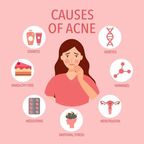 "Unmasking Acne: Understanding Its Origins" Delve into the root causes of acne and discover ways to unveil clearer, healthier skin. #AcneAwareness #ClearSkinJourney #acne #acneprone #acnetreatment #acnestudios #acneskin #soulbeautycosmetology #acnecauses Cause Of Acne, Causes Of Acne, Acne Causes, Healthier Skin, Unhealthy Food, Acne Skin, Cosmetology, Clear Skin, Allergies