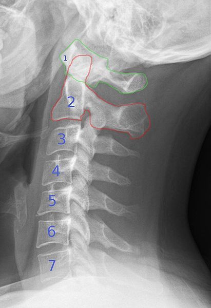 Punkty Spustowe, Cervical Pain, Cervical Spondylosis, Neck Pain Relief, Leg Pain, Sciatica, Neck Pain, Massage Therapy, Migraine