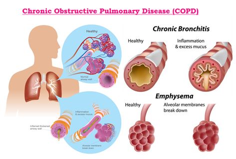 Emt Study, Chest Infection, Arterial Blood Gas, Medical Study, Chesty Cough, Study Essentials, Oxygen Therapy, Chronic Obstructive Pulmonary Disease, Respiratory Therapy