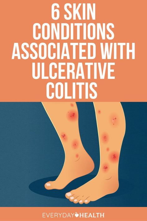 Ulcer Colitus Recipes, Ulcer Diet, Posture Tips, Rash Causes, Leg Ulcers, Gastrointestinal Tract, Stomach Ulcers, Canker Sore, Oral Health Care