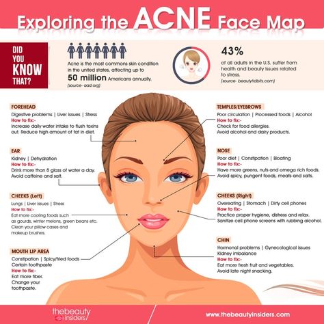 What Does Acne Mean Face Mapping, Acne Reasons Face Mapping, Reasons Of Pimples On Face, Reasons Of Acne On Face, Acne Face Mapping Remedies, Facial Mapping Acne, Where My Acne Is And What It Means, What My Acne Is Telling Me, What Is Your Acne Telling You