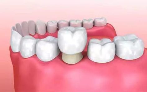 Dental Crown Dental Crown Procedure, Clove Dental, Dental Bridge Cost, Temporary Crown, Tooth Crown, Kedokteran Gigi, Dental Implant Surgery, Dental Implants Cost, Dental Fillings