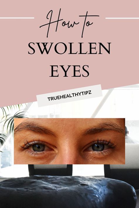 Swollen Face Remedies, Swollen Eyelids Remedy, Facial Swelling, Swollen Eyelid, Sunburn Peeling, Natural Face Care, Swollen Eyes, Under Eye Puffiness, Perfect Skin Care Routine